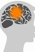 Image result for Childhood Brain Cancer