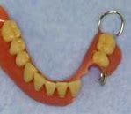 Image result for Acrylic Denture with Wrought Wire Clasps