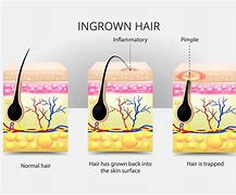 Image result for Ingrown Hair Causing Boils