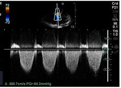 Image result for Continuous Wave Doppler Ultrasound