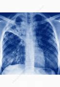 Image result for Severe Acute Respiratory Syndrome