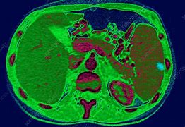 Image result for Spleen Infarction Ultrasound