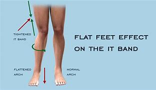 Image result for Flat Feet