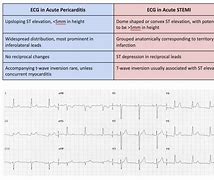 Image result for Pericarditis EKG Findings Example