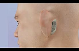 Image result for Mastoiditis Draining