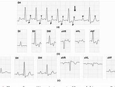 Image result for Atrioventricular Reciprocating Tachycardia