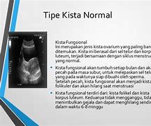 Image result for Kista Coklat Adalah