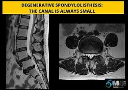 Image result for Pars Defect Lumbar Spine