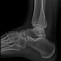 Image result for Lateral Malleolus Fracture Splint