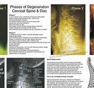 Image result for Spinal DIC Chart