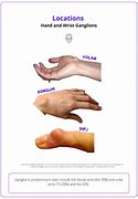 Image result for Cyst On Wrist