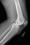 Image result for Normal Lateral Knee Radiograph