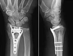 Image result for Volar Fracture