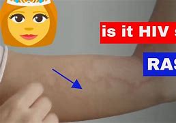 Image result for HIV Bumps On Fingers