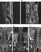 Image result for Mid Coronal Plane