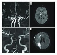 Image result for MRI Angiography