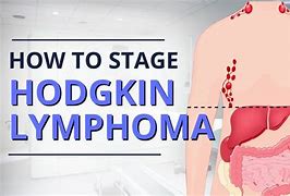 Image result for Hodgkin Lymphoma Cancer Symptoms