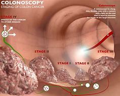 Image result for Pics of Colon Cancer