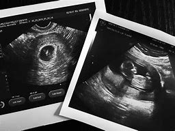 Image result for 13 Week Baby Ultrasound