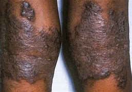 Image result for Groin Eczema Treatment