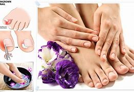 Image result for Pedicure for Ingrown Toenail