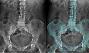 Image result for Sclerosis Bone Metastases X-ray