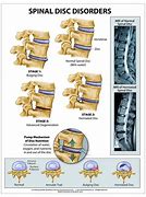 Image result for Spinal DIC Chart