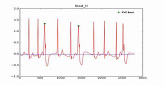 Image result for Unifocal PVC Bigeminy