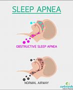 Image result for Obstructive Sleep Apnea and Hypertension