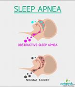 Image result for Sleep Apnea Treatment