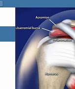 Image result for Sasd Bursitis