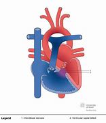 Image result for Right Ventricular Outflow Tract