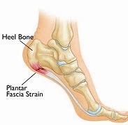 Image result for Severe Plantar Fasciitis