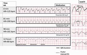 Image result for Ventricular Flutter and Fibrillation