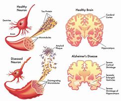 Image result for ALZ Disease