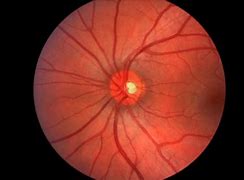 Image result for Papilledema