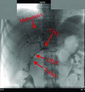 Image result for Tace Ablation