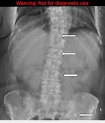 Image result for Bone Metastasis X-ray