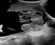 Image result for Male Baby Ultrasound