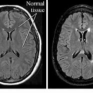 Image result for Abnormal MRI Scans