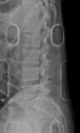 Image result for Compression Fracture Lumbar Surgery