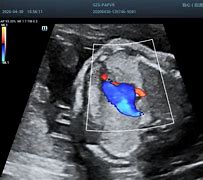 Image result for Abnormal Fetal Heart Ultrasound