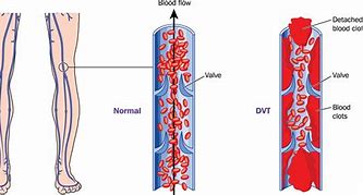 Image result for Thrombotic Veins