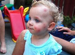 Image result for Baby Bed Bug Bites