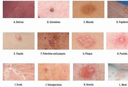 Image result for Raised Circular Lesion On Skin