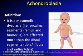 Image result for Achondroplasia X-ray