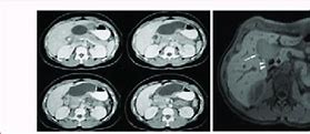 Image result for Biloma Ultrasound Images Post-Cholecystectomy