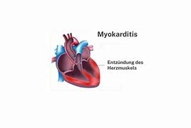 Image result for Myokarditis