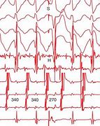 Image result for Atrioventricular Reciprocating Tachycardia