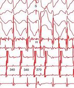 Image result for Atrioventricular Reciprocating Tachycardia